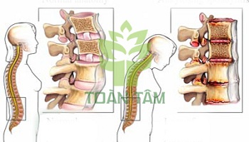 Hình 5: Các bệnh về xương